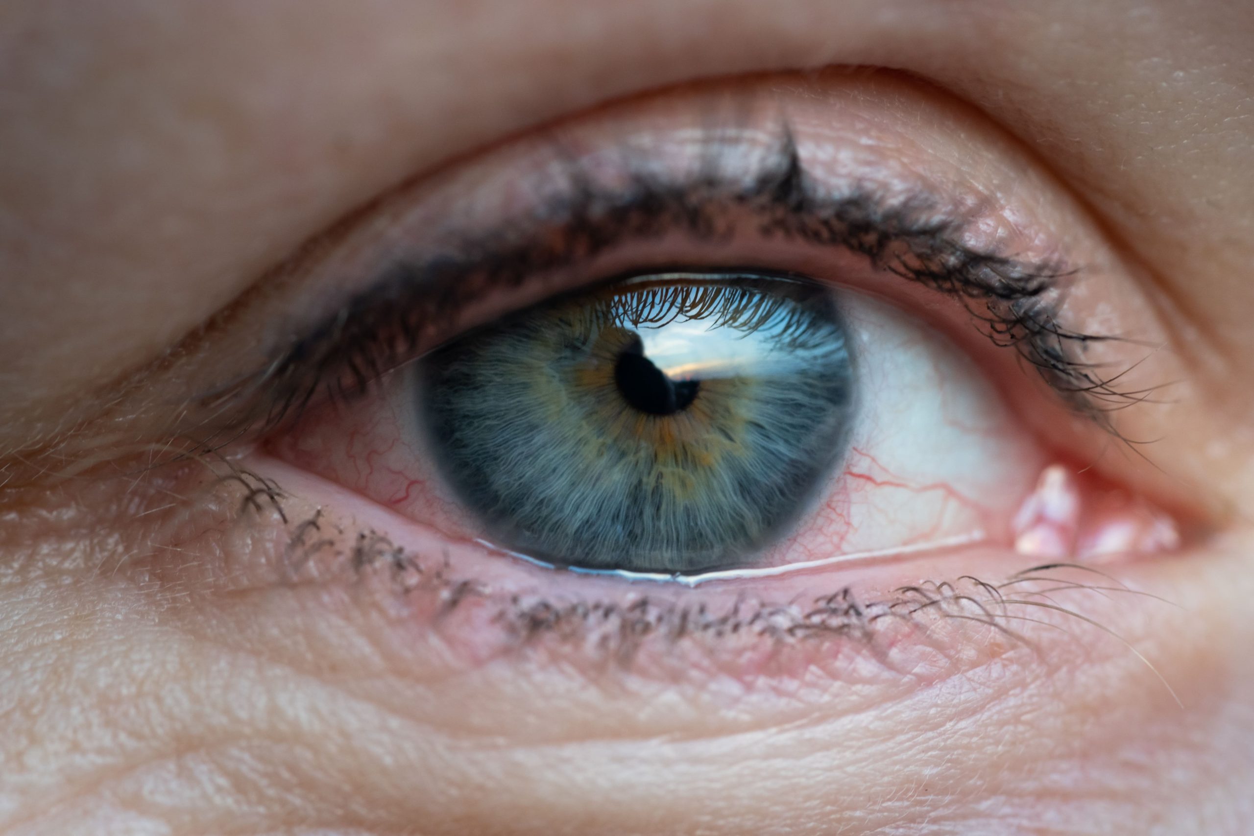 Синдром сухого глаза: причины, симптомы, лечение